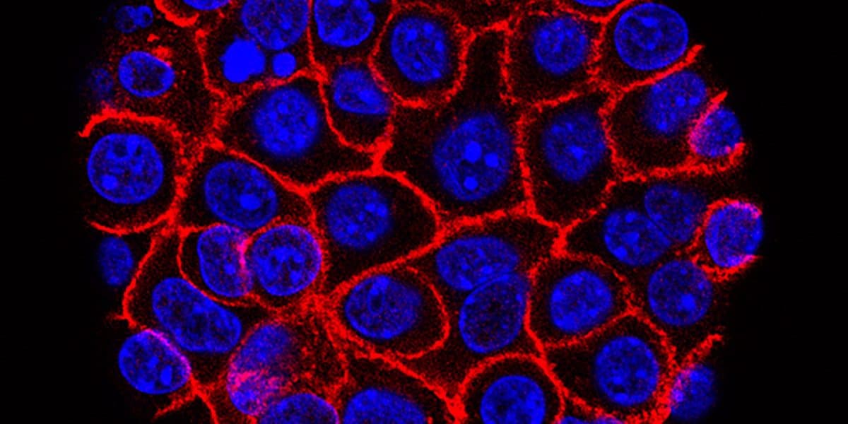 Experimental Cancer Drug Doubles Survival Time for Advanced Pancreatic Cases